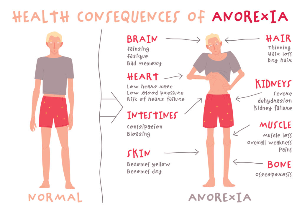 Anorexia Nervosa